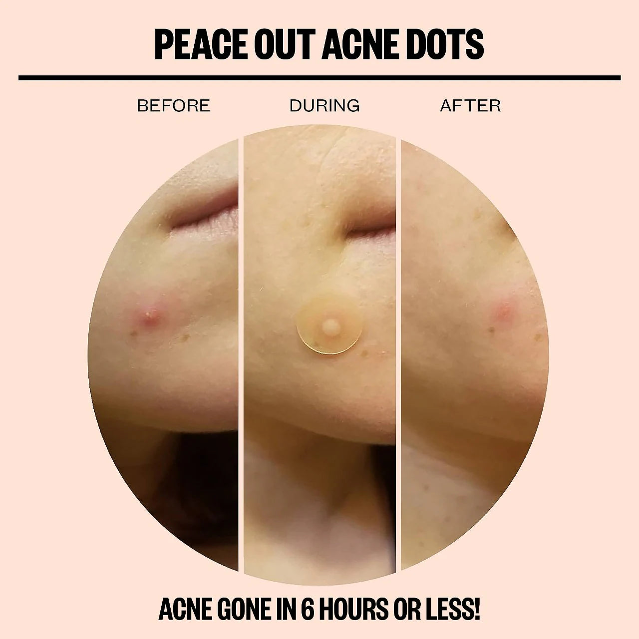 Peace Out Salicylic Acid Acne Healing Dots *Pre-Orden*